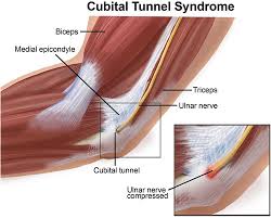 Ảnh 4 của Cubital Tunnel Syndrome